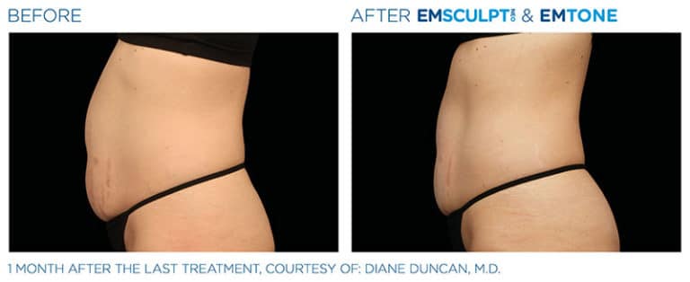 EMSCULPT NEO before and After