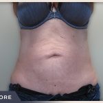 Abdominoplasty Before & After Patient #758
