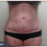 Abdominoplasty Before & After Patient #758