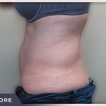 Abdominoplasty Before & After Patient #758
