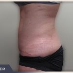 Abdominoplasty Before & After Patient #758