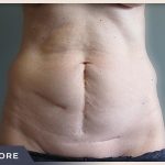 Abdominoplasty Before & After Patient #760
