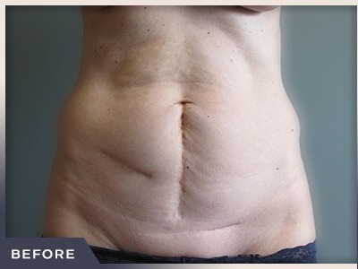 Abdominoplasty Before & After Patient #760