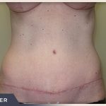 Abdominoplasty Before & After Patient #760