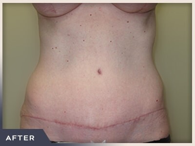Abdominoplasty Before & After Patient #760