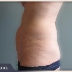 Abdominoplasty Before & After Patient #760