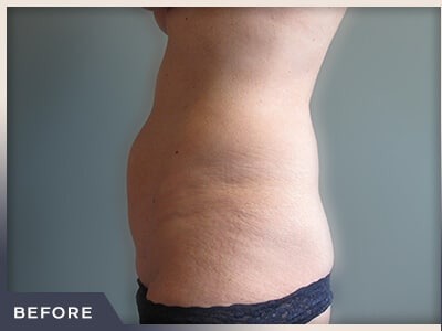 Abdominoplasty Before & After Patient #760