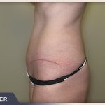 Abdominoplasty Before & After Patient #760