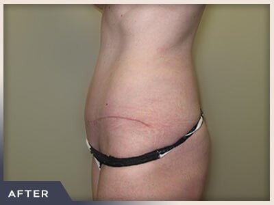 Abdominoplasty Before & After Patient #760