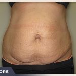Abdominoplasty Before & After Patient #762