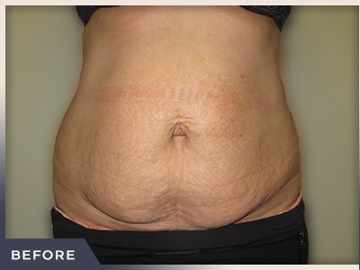 Abdominoplasty Before & After Patient #762