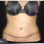 Abdominoplasty Before & After Patient #762