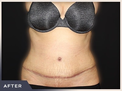 Abdominoplasty Before & After Patient #762