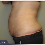 Abdominoplasty Before & After Patient #762