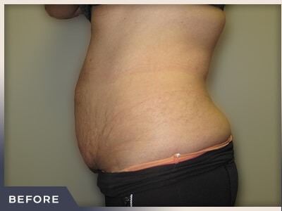 Abdominoplasty Before & After Patient #762