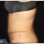 Abdominoplasty Before & After Patient #762