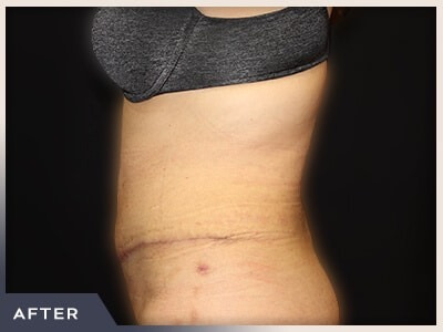 Abdominoplasty Before & After Patient #762