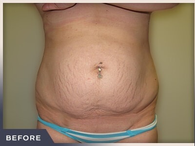 Abdominoplasty Before & After Patient #763