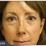 Blepharoplasty Before & After Patient #791