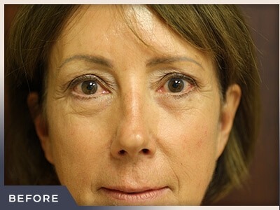Blepharoplasty Before & After Patient #791