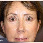 Blepharoplasty Before & After Patient #791