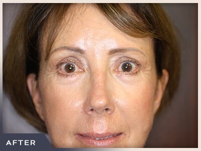 Blepharoplasty Before & After Patient #791