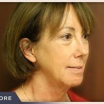 Blepharoplasty Before & After Patient #791