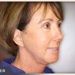 Blepharoplasty Before & After Patient #791