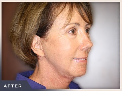 Blepharoplasty Before & After Patient #791