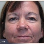 Blepharoplasty Before & After Patient #790
