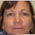 Blepharoplasty Before & After Patient #790