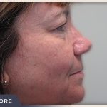 Blepharoplasty Before & After Patient #790
