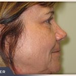 Blepharoplasty Before & After Patient #790
