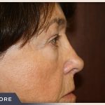 Blepharoplasty Before & After Patient #789
