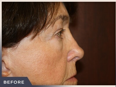 Blepharoplasty Before & After Patient #789