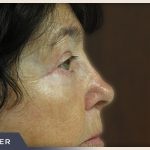 Blepharoplasty Before & After Patient #789