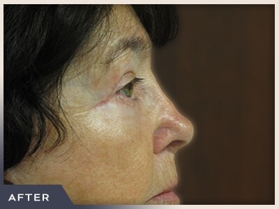 Blepharoplasty Before & After Patient #789