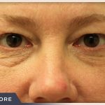Blepharoplasty Before & After Patient #787