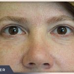 Blepharoplasty Before & After Patient #787