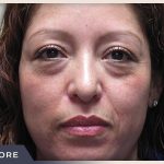 Blepharoplasty Before & After Patient #785