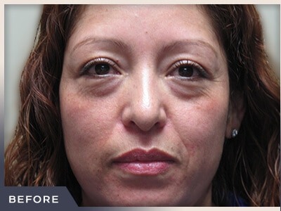 Blepharoplasty Before & After Patient #785