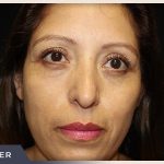 Blepharoplasty Before & After Patient #785