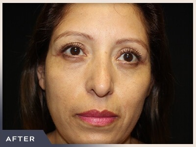 Blepharoplasty Before & After Patient #785