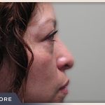 Blepharoplasty Before & After Patient #785