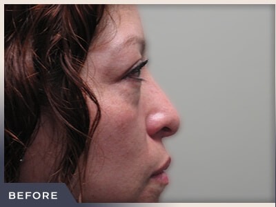 Blepharoplasty Before & After Patient #785