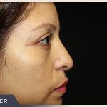 Blepharoplasty Before & After Patient #785