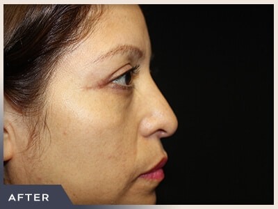 Blepharoplasty Before & After Patient #785