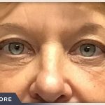Blepharoplasty Before & After Patient #784