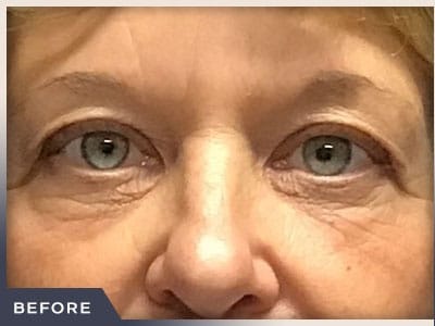 Blepharoplasty Before & After Patient #784