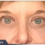 Blepharoplasty Before & After Patient #784